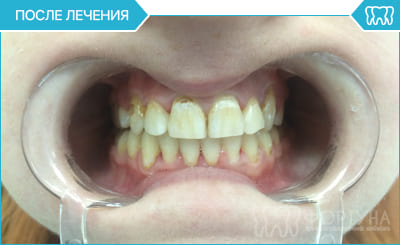 після лікування