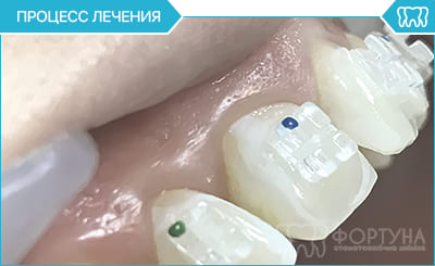 процес лікування