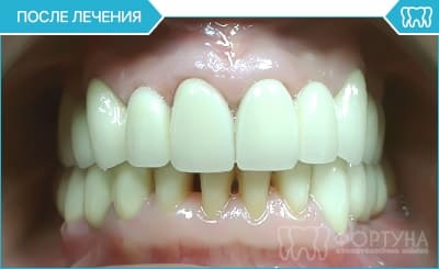після встановлення металокерамічної коронки