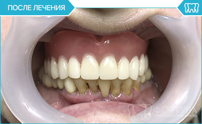 установка съемных протезов