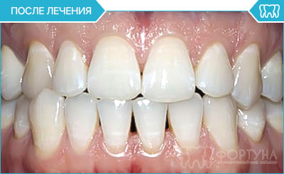 домашнє відбілювання зубів - після лікування