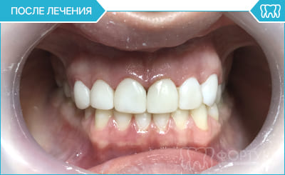 ПІСЛЯ художньої реставрації зубів