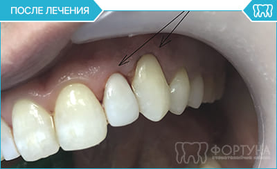 Лікування карієсу зубів - після лікування
