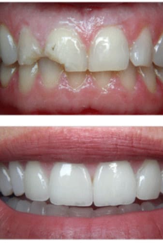 Veneers-Before-and-After