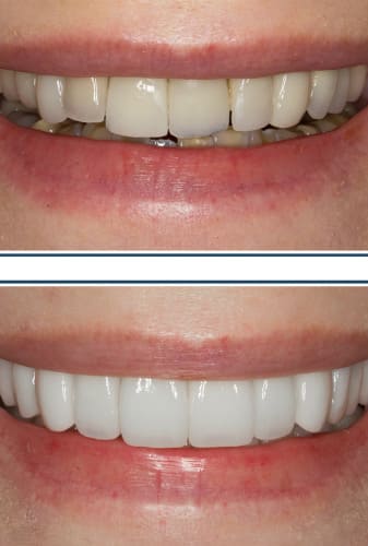 Before-and-After-Veneers