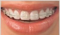 Ceramic-braces