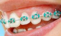 Metal-braces