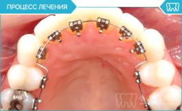 Лингвальные брекеты - процесс лечения